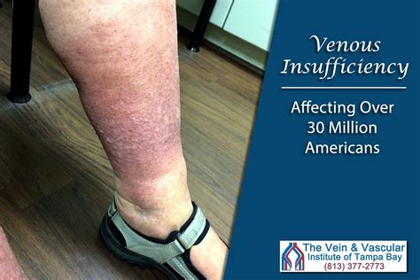 venous leak exercise|Exercises to Help Venous Insufficiency 